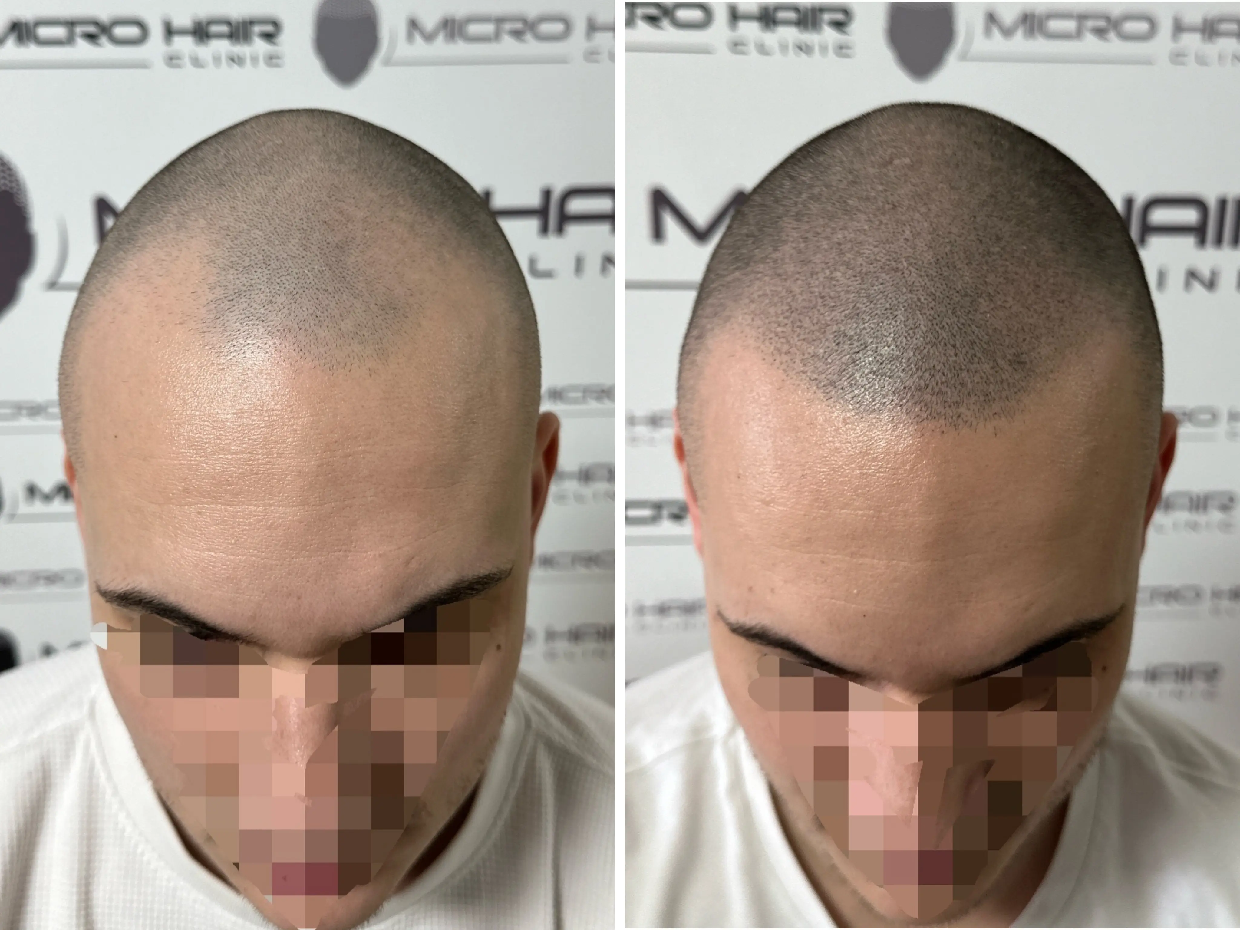 SMP rezultat pred in po - tretman mikropigmentacije 1